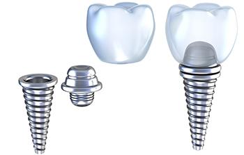 牙齿缺失多颗怎么办?